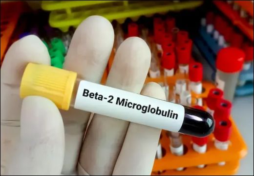 Beta-2 Microglobulin (B2M) Test