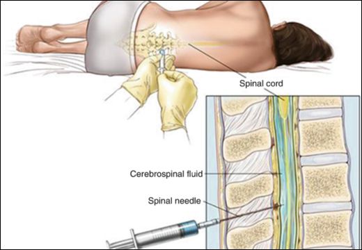 Cerebrospinal Fluid (CSF) Analysis