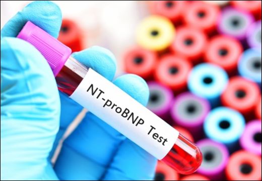 NT-ProBNP Test NT-ProBNP Test