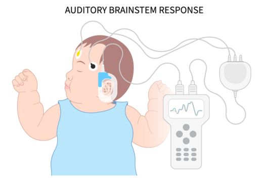 Auditory Brainstem Response (ABR/BERA) Test Auditory Brainstem Response (ABR/BERA) Test