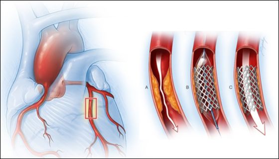 Coronary Angiography