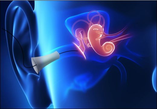Electrocochleography (ECoG) Test Electrocochleography (ECoG) Test