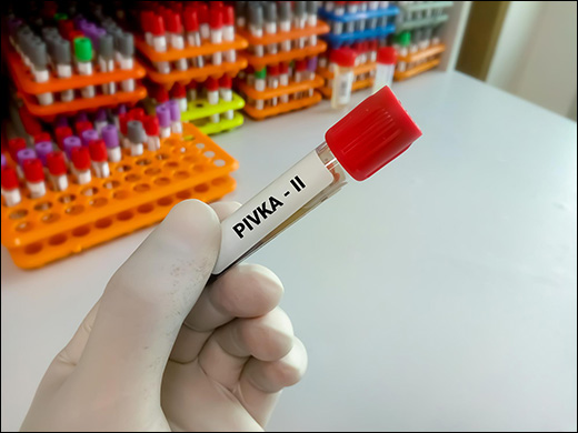 DCP (Des-gamma-carboxy Prothrombin), PIVKA-II Test