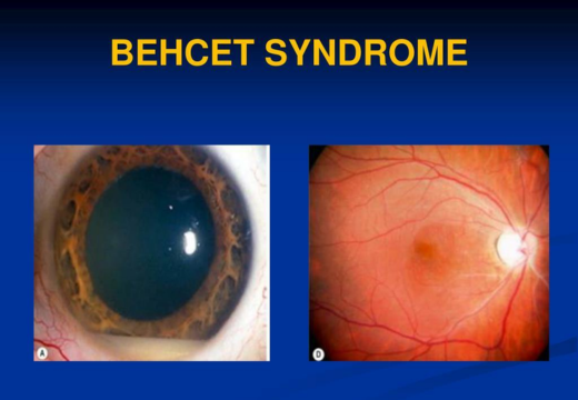 Behcet’s