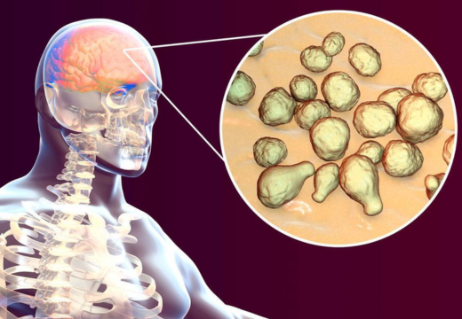 Cryptococcosis, Herbs A to Z