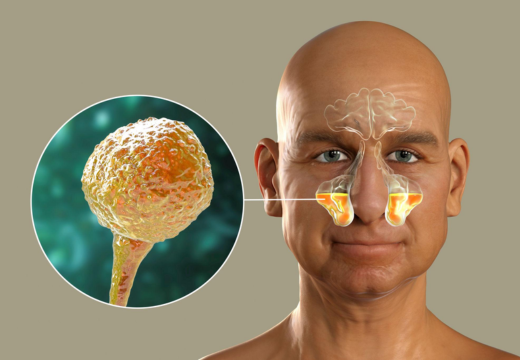 Mucormycosis, Herbs A to Z