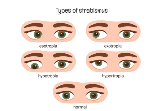 Squint (Strabismus)