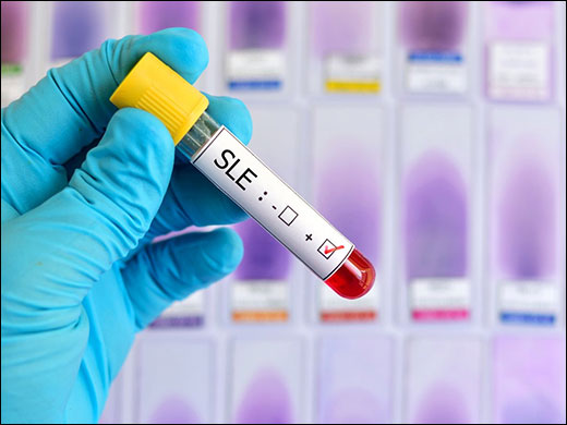 Diagnosis of Systemic Lupus Erythematosus (SLE) Key Laboratory Tests Used in the Diagnosis of Systemic Lupus Erythematosus (SLE)